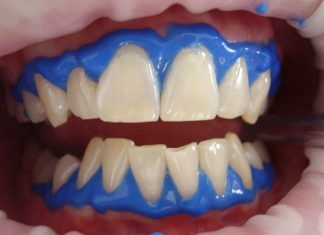 Les restaurations composites