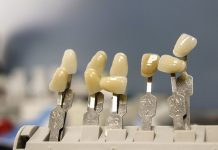 Les inlays, onlays, overlays