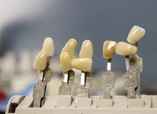 Les inlays, onlays, overlays